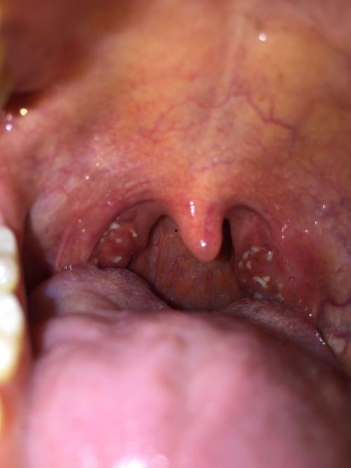 吃瓜后喉咙发涩